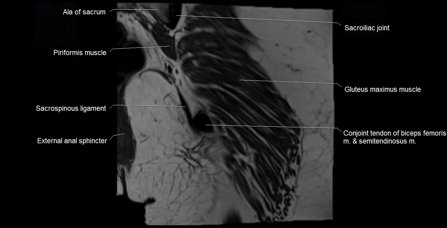 MRI Hip 3T coronal cross sectional anatomy image 57.webp